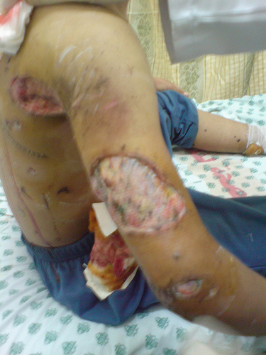 Skador oskadade av vit fosfor på en civil palestinier, 2009.