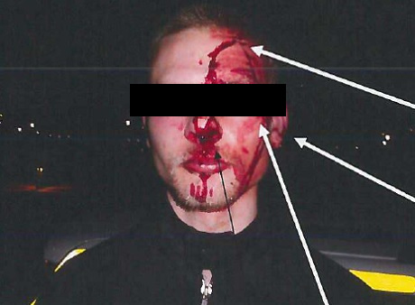 Bild från polisens förundersökning på "Niklas" som blev grovt misshandlad när den stora gruppen vänsterextrema hann ikapp.